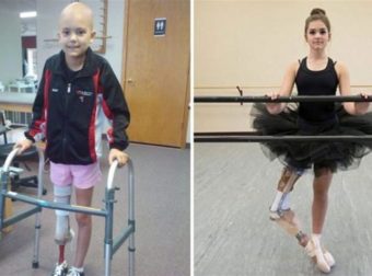 15χρονη μπαλαρίνα που έχασε το πόδι της από καρκίνο σήμερα χορεύει ξανά