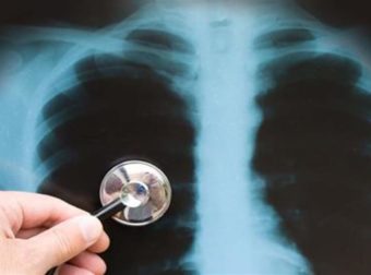 Φυματίωση: Αυξάνεται ο αριθμός των θανάτων στην μετα-COVID περίοδο