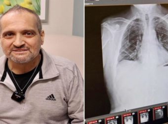 ΗΠΑ: Διπλή μεταμόσχευση πνευμόνων σε ασθενή που έπασχε από καρκίνο στο τελευταίο στάδιο