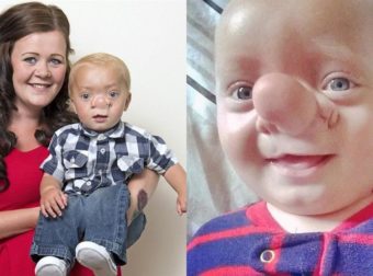 O «Πινόκιο της πραγματική ζωής»: Το παιδί που ο εγκέφαλός του μεγαλώνει στη μύτη του εξαιτίας σπάνιας πάθησης