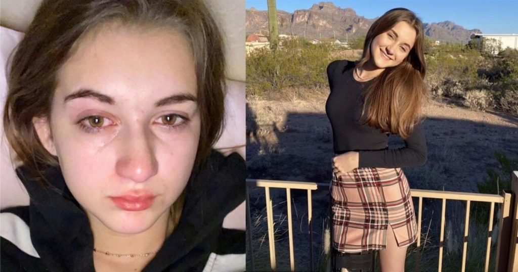 «Πονάω στο ντους και νιώθω τα δάκρυα σαν οξύ»: Η 15χρονη που είναι αλλεργική στο νερό περιγράφει τη ζωή της