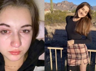 «Πονάω στο ντους και νιώθω τα δάκρυα σαν οξύ»: Η 15χρονη που είναι αλλεργική στο νερό περιγράφει τη ζωή της