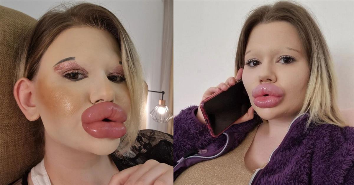 24χρονη εθισμένη στις πλαστικές παραφούσκωσε τα χείλη της, μοιάζει με πάπια αλλά νομίζει ότι είναι κουκλάρα